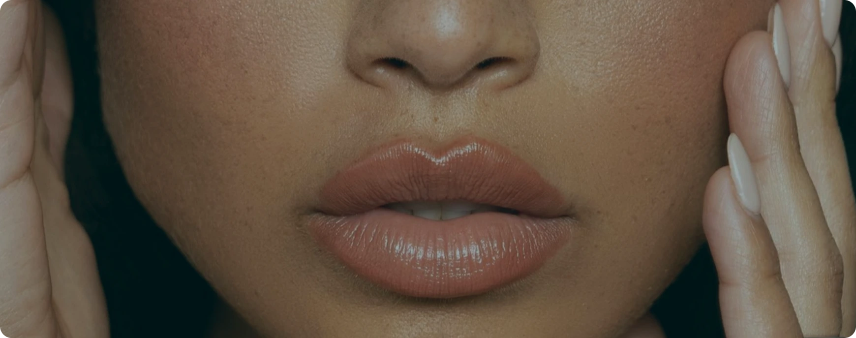 Upper Lip Lift
